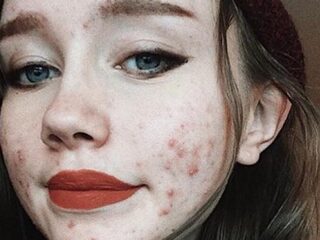 Hailey (17) maakt acneselfies op Instagram