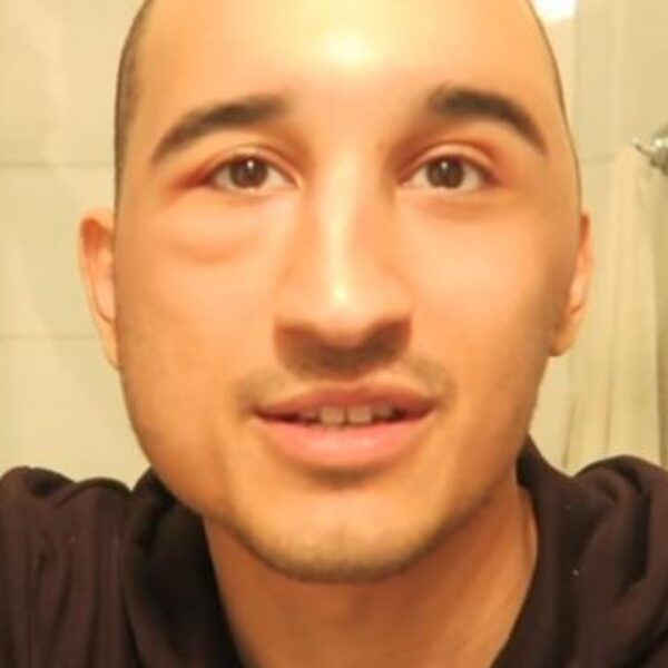 Nesim Najih deelt heftige beelden van haartransplantatie met zijn volgers