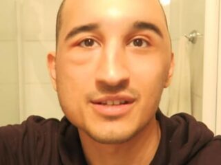 Nesim Najih deelt heftige beelden van haartransplantatie met zijn volgers