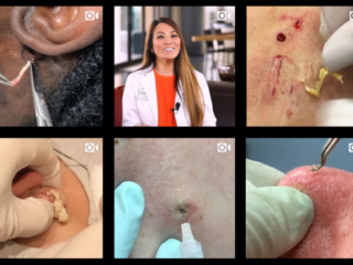 Puistenuitknijper Dr. Pimple Popper zoekt patiënten voor show