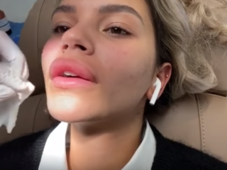 Monica Geuze laat lipfillers verwijderen: "Het lijkt alsof het is gaan ophopen"