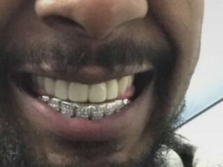Danny Brown laat zijn gebit herstellen