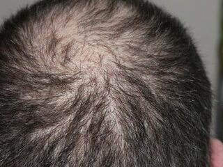 Ga als een gladiator de strijd tegen kaalheid aan!