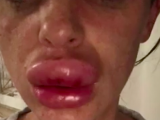 Vrouw kon doodgaan aan lipfillers op botoxparty