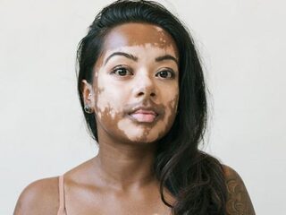 Fotograaf maakt prachtige foto's van modellen met vitiligo