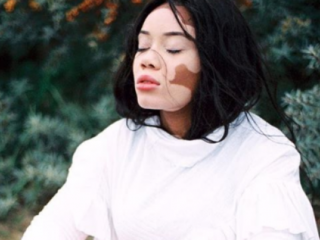 Het Rotterdamse model Deborah heeft vitiligo en is daar trots op