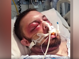 Kerkprediker vecht voor zijn leven na giftige slangenbeet