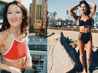 26-jarig meisje start modellencarrière ondanks bijzondere huidaandoening