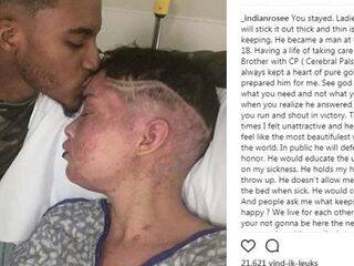 Jonge vrouw met auto-immuunziekte lupus schrijft ode aan haar man