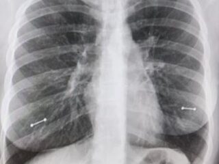 Moeder ontdekt tepelpiercings bij dochter door röntgenfoto