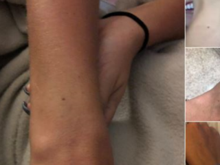 Vrouwen op Twitter worden gek: bijna iedereen heeft dezelfde moedervlek