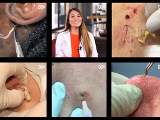 Puistenuitknijper Dr. Pimple Popper zoekt patiënten voor show