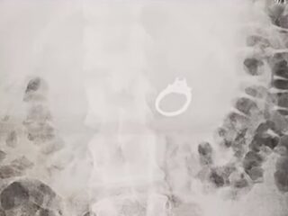 Vrouw slikt verlovingsring door na gebeurtenis in nachtmerrie