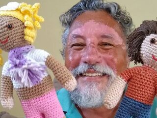 Man met vitiligo maakt speciale poppen voor kids met een aandoening