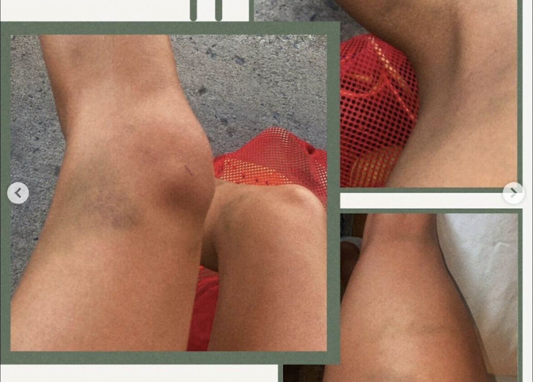 Blauwe plekken op de knieën van zwemster Mary-Sophie Harvey