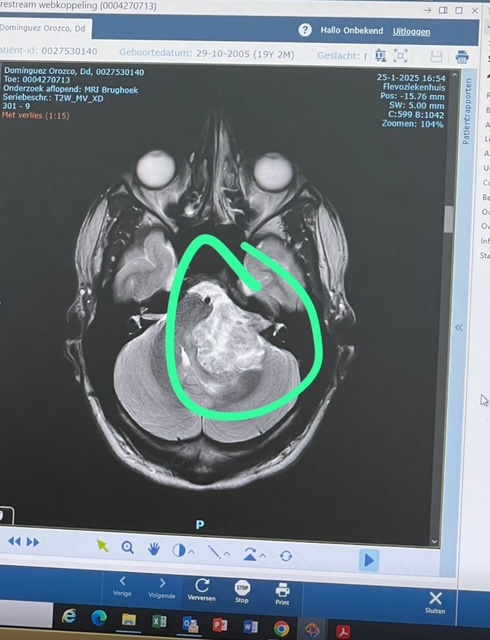Dylan (19) moet hersenoperatie ondergaan vanwege tumor: