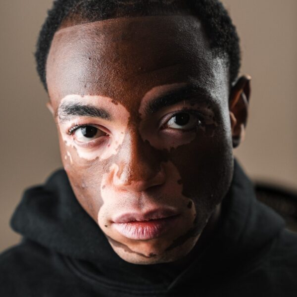 Terence (23) verborg zijn gezicht jarenlang wegens vitiligo: "Ik wilde mensen niet laten schrikken"