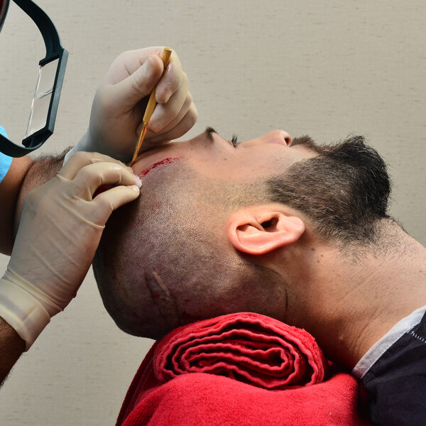 Gerben (29) en Danny (28) ondergingen haartransplantatie: "Een boost voor je zelfvertrouwen"