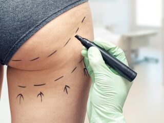 Cosmetische ingrepen in het buitenland: is dat gevaarlijker of niet?