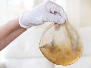 Duizenden mensen sluiten zich aan bij massaclaim om slechte borstimplantaten