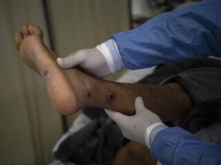 Noodtoestand uitgeroepen wegens nieuwe 'apenpokken' variant: Komt mogelijk weer naar Europa