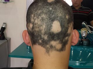 Arda (25) heeft haarverlies door alopecia: "Grappen kunnen aan je blijven knagen"