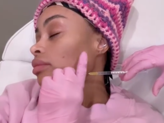 Weg met de botox: deze beroemdheden laten hun fillers weghalen