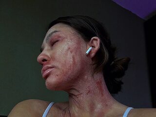 Cansu (23) lijdt aan de heftige huidaandoening TSW: "Het is heel zwaar"