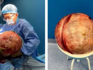Chirurgen verwijderen tumor van 30 kilo bij vrouw (65) na maanden van mysterieuze pijn