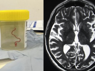 Levende worm uit hersenen van Australische vrouw gehaald