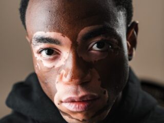 Terence (23) verborg zijn gezicht jarenlang wegens vitiligo: "Ik wilde mensen niet laten schrikken"