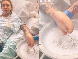 Vrouw komt met misvormde hand uit niersteenoperatie