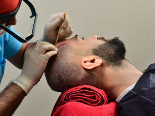 Gerben (29) en Danny (28) ondergingen haartransplantatie: "Een boost voor je zelfvertrouwen"