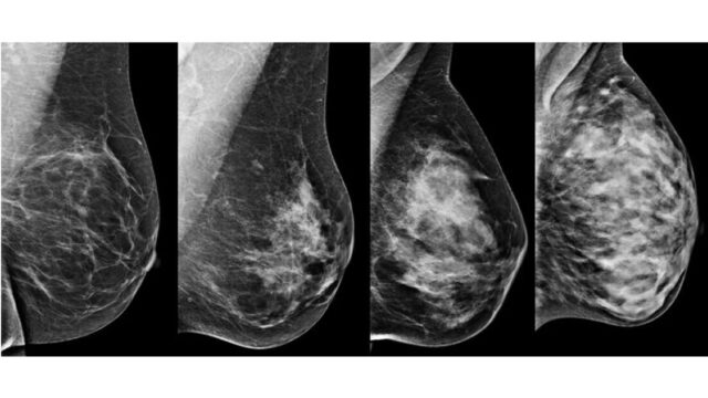 Podcast De Dag: als ze de tumor in je borst niet zien