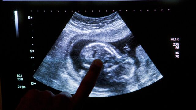 Verloskundigen zien abortus om geslacht van het kind na pretecho