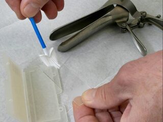 RIVM: jaarlijks tientallen doden door negeren oproep uitstrijkje