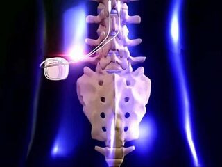 Met ruggenmergstimulatie de opiatencrisis te lijf
