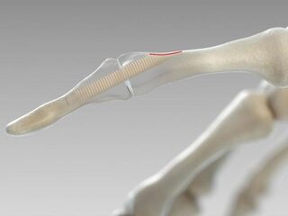 Een nieuwe schroef voor botbreuken is voortaan van echt bot