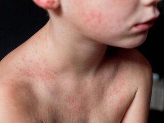 Offensief tegen vaccinatieweigeraars: staatssecretaris Blokhuis nodigt ze uit voor gesprek