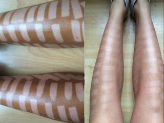 Brandwonden door ontharingsbehandeling: 'Denk goed na voordat je een goedkope behandeling boekt'