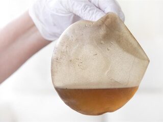 Ernstige gezondheidsklachten door borstimplantaten: 'Volgens specialisten had ik een burn-out'