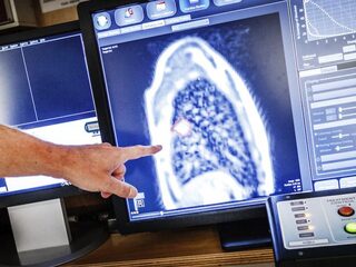 Zeldzame kankersoorten te vaak te laat ontdekt, KWF investeert miljoenen om diagnose te verbeteren