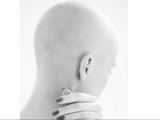 Sandra verloor in 4 dagen al haar haren