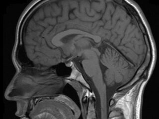 Het verschil tussen mannen- en vrouwenhersenen