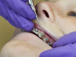 Steeds meer beugelbekkies in Nederland: 'Het is voor een derde een esthetische keuze'