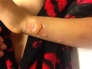 Kinderen lopen flinke brandwonden op door reuzenberenklauw