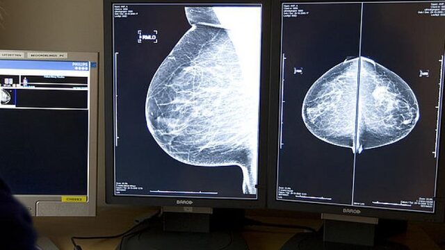 Aantal diagnoses van kanker neemt af: 'Wacht nu niet met naar de huisarts gaan'