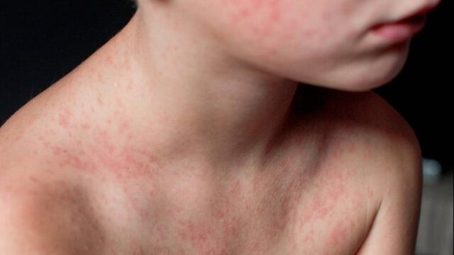 Offensief tegen vaccinatieweigeraars: staatssecretaris Blokhuis nodigt ze uit voor gesprek