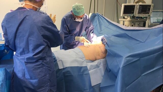 Studie: Eigen vet voor borstreconstructie wel veilig