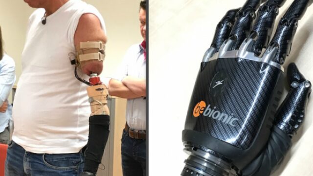 Eerste Nederlander krijgt met gedachten aan te sturen robotarm